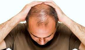 calvicie