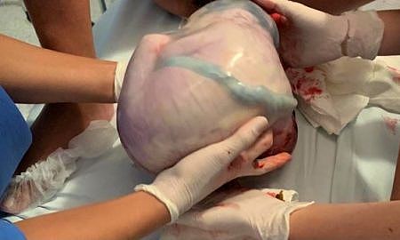 parto raro e realizado no hospital materno infantil santa catarina de criciuma 20201105 1805806328