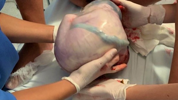 parto raro e realizado no hospital materno infantil santa catarina de criciuma 20201105 1805806328